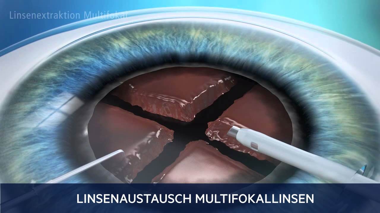 Multifokale Linsenaustausch, Augenärzte Wien, Dirisamer Luft Priglinger